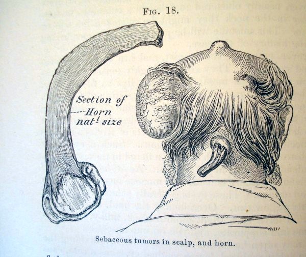 sebaceous tumor of the scalp
